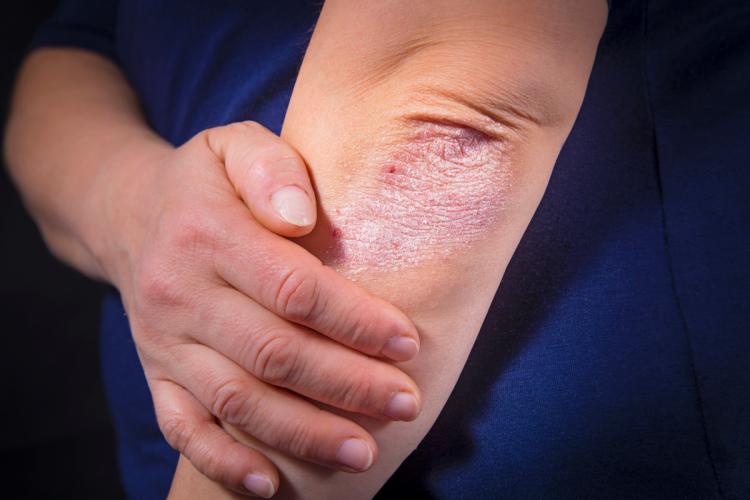 Psoriasis_-_Getty_Images.jpg